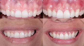 New Dental Implants Service In Richboro PA: Transform Your Smile Today