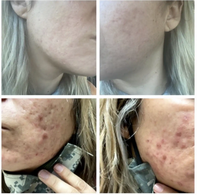 Dermapen Microneedling Near Me - World Of Beauty Miami