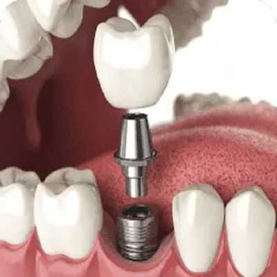 Improving Your Smile: The Aesthetic Benefits of Dental Implants